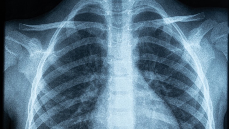 X-ray of a chest